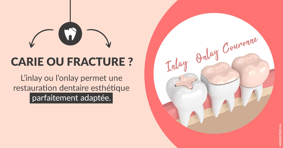 https://www.espace-dentaire-wambrechies.fr/T2 2023 - Carie ou fracture 2
