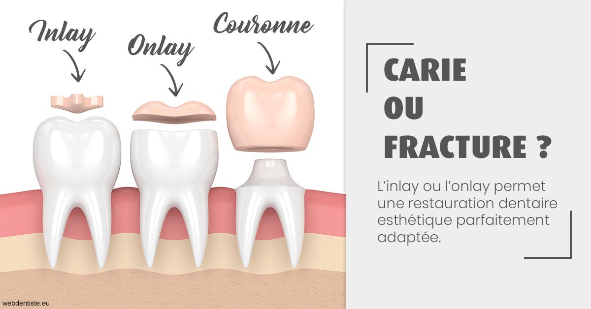 https://www.espace-dentaire-wambrechies.fr/T2 2023 - Carie ou fracture 1