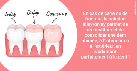 https://www.espace-dentaire-wambrechies.fr/L'INLAY ou l'ONLAY 2